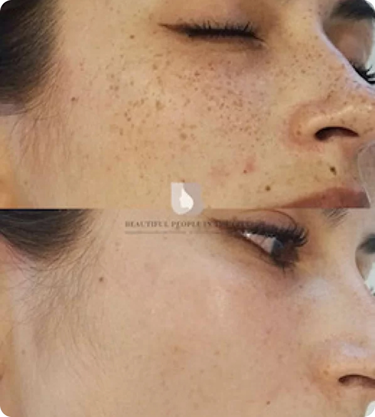 Лазерная шлифовка кожи лица: видео отзывы, фото до и после