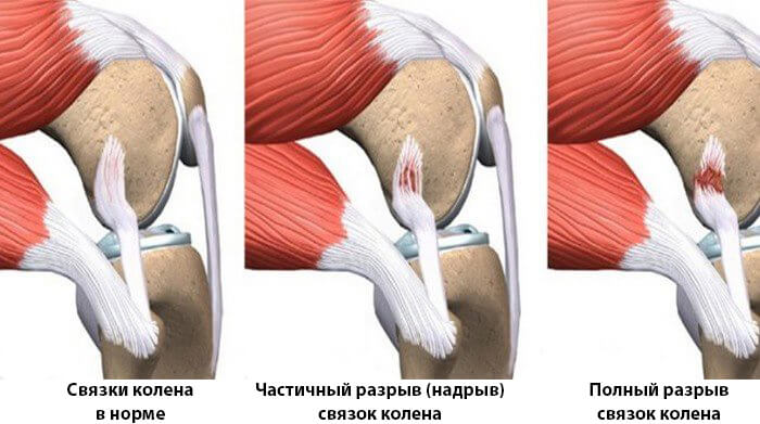 Лечение повреждений связок локтевого сустава:от симптоматики до прогнозов для спортсменов