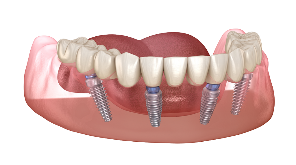 Протез на имплантах при полном отсутствии. Имплантация зубов по технологии «all on 4». Имплантация челюсти на 4 имплантах. Покрывной протез на 4 имплантах.