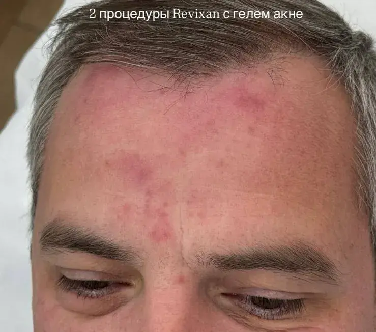 Воспалительные высыпания на лбу у мужчины, после
