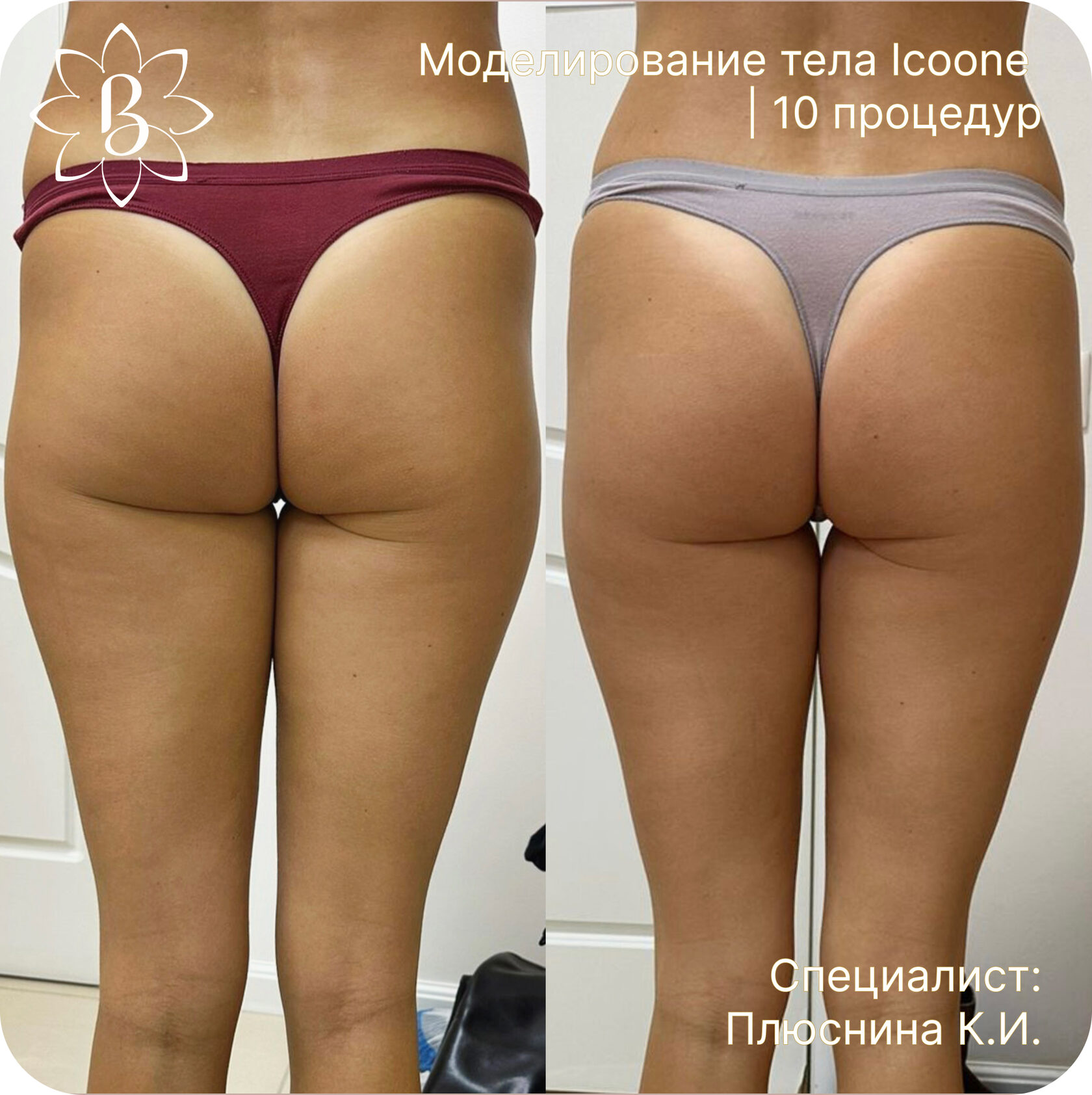 Диодная лазерная эпиляция СПб