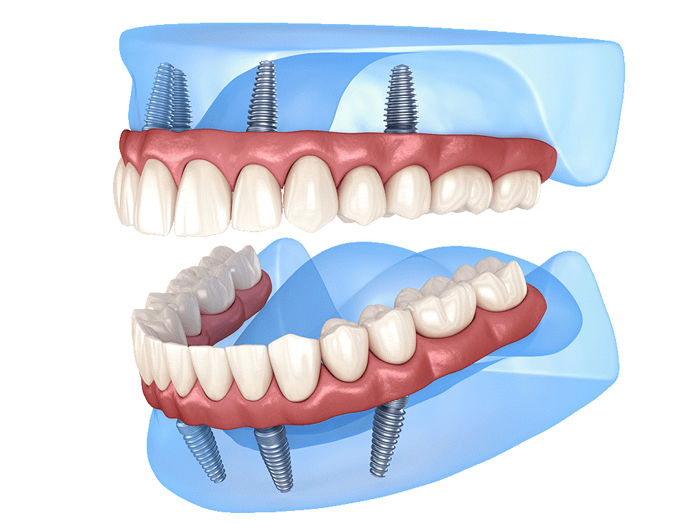 Имплантация зубов по технологии «all on 4». All 4 протезирование челюсти. Имплантация челюсти на 4 имплантах. Имплант челюсти на 4 штифтах.