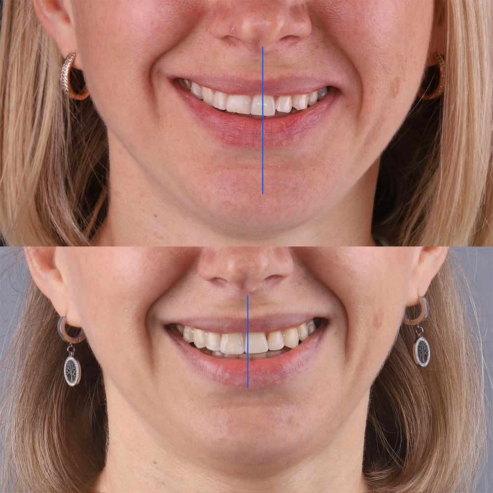 Лечение на элайнерах FlexiLigner