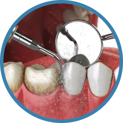 Установка имплантов в Дербенте. Имплантация при отсутствии одного зуба.