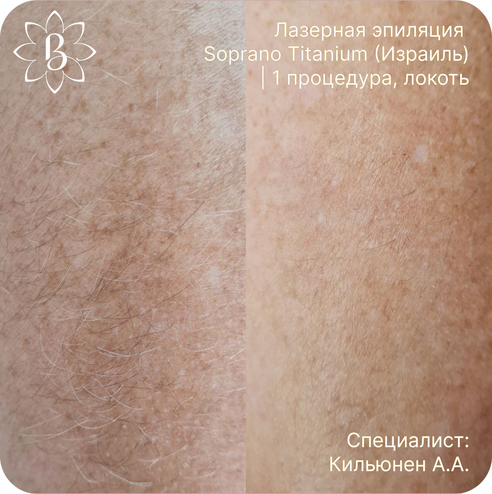 лазерная эпиляция ног