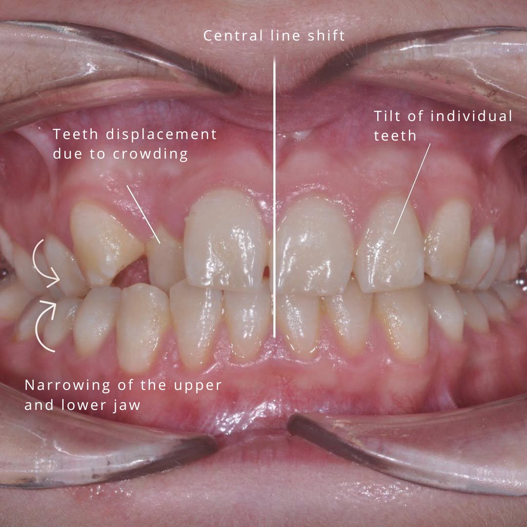After treatment view showing corrected midline and resolved crowding — photo 2 of 2