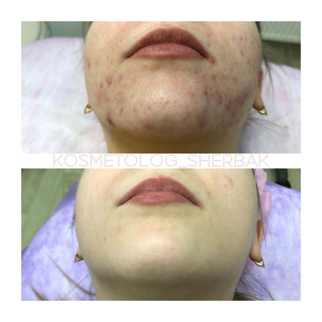 Лечение акне у женщины в клинике PradusCOSMO, СПб. До и после процедуры