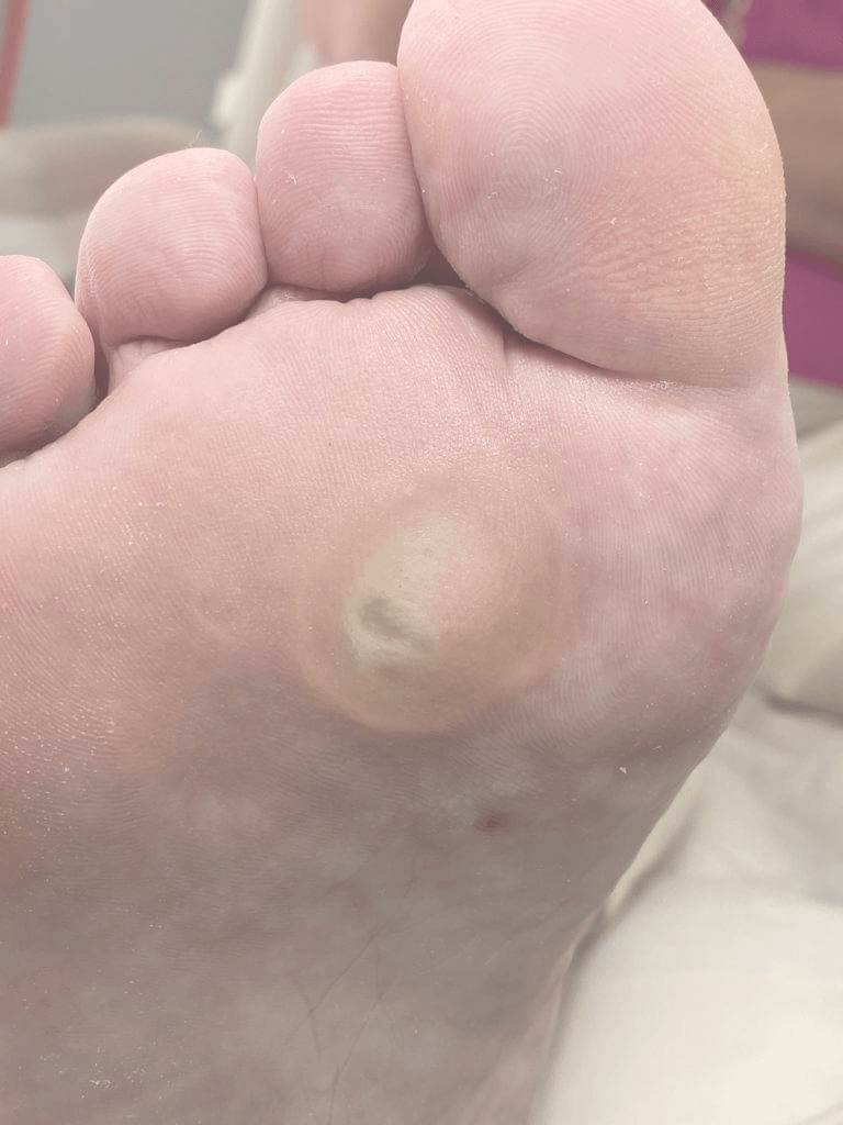 Натоптыши мозоли