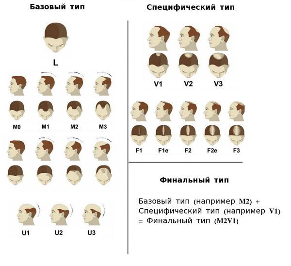 Классификация андрогенетической алопеции BASP