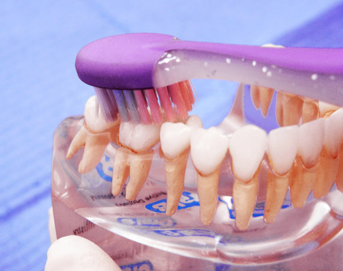 Камни на зубах | Как убрать зубной камень (чистка) | Как выглядит | Чем опасен