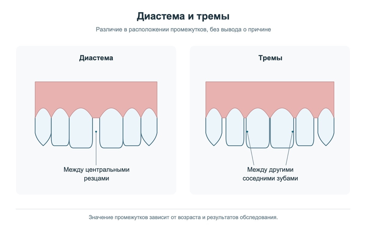 Схема диастемы между центральными резцами и трем между зубами