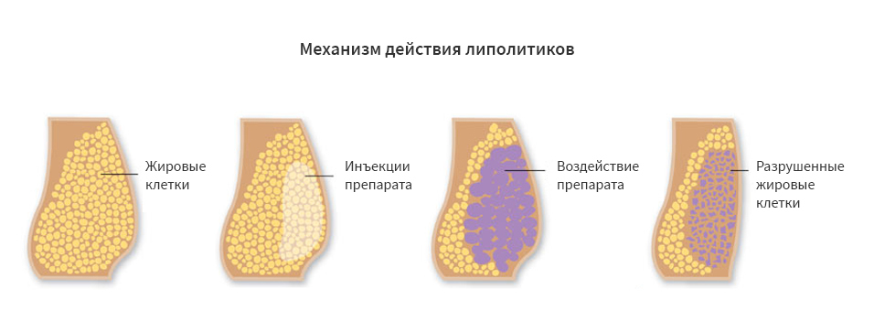 Как колоть липолитик в лицо схема