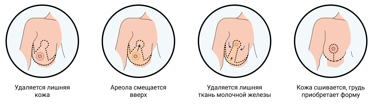 Что влияет на форму груди? Анатомия