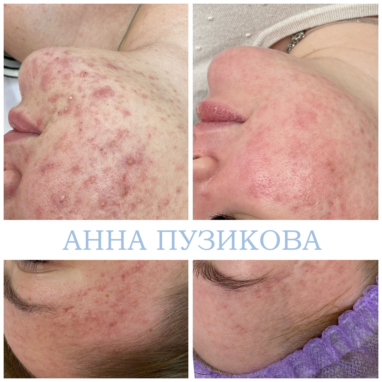Результат лечения акне и воспалений кожи после курса процедур у косметолога Анны Пузиковой в клинике Прадус (СПб).