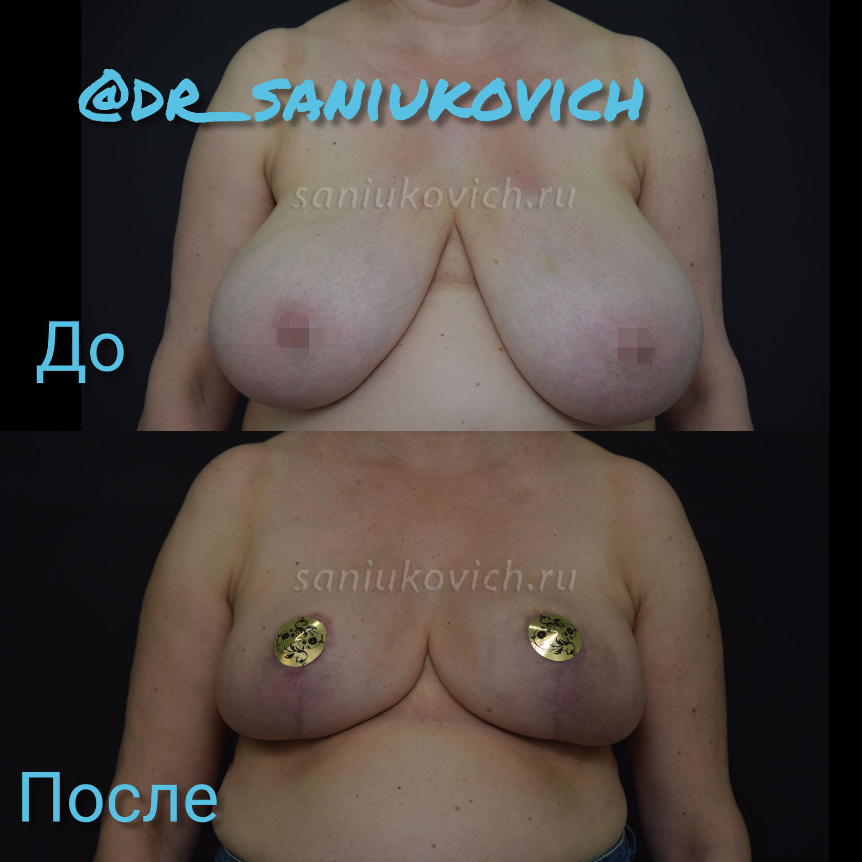 таблетки для уменьшения груди у женщин фото 117
