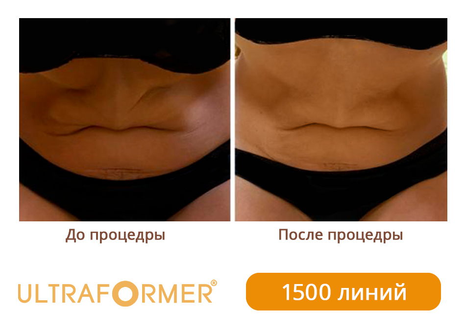 Ультраформер отзывы до и после