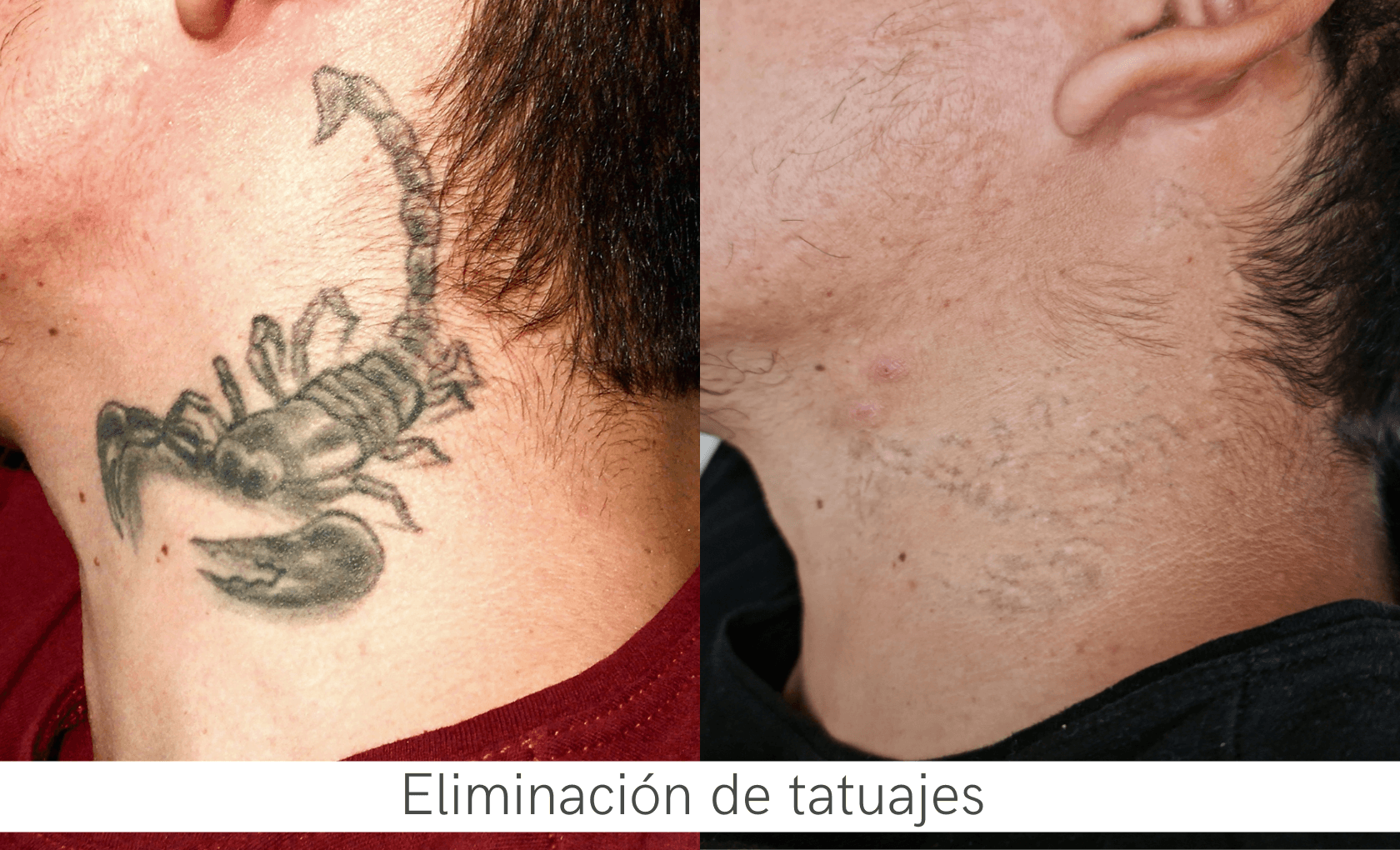 Eliminación de Tatuajes