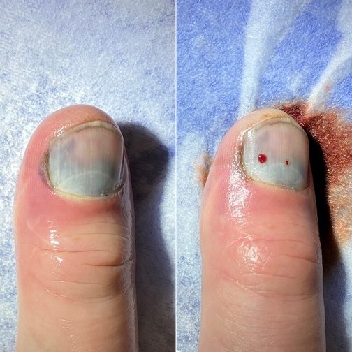 Травма ногтя - гематома