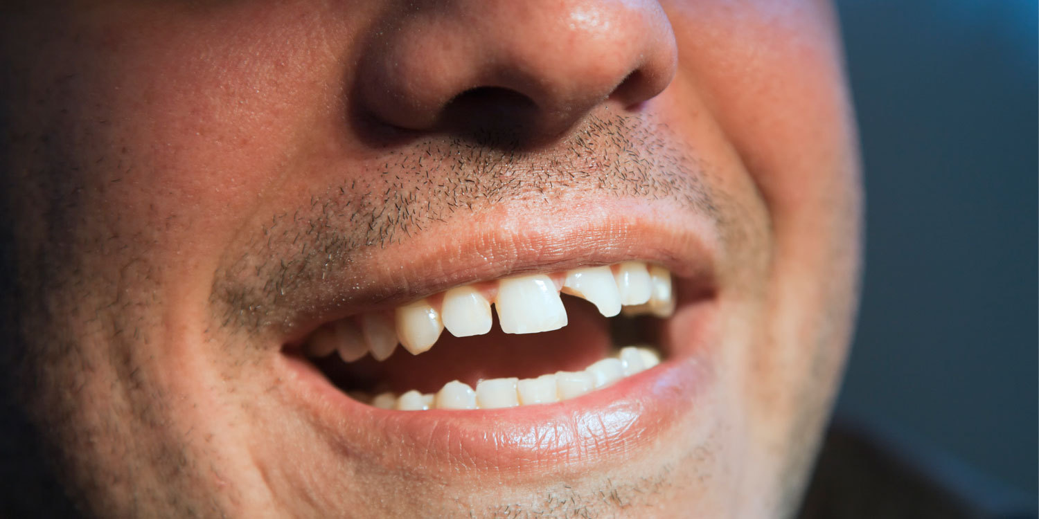 Причины разрушения зубов — Стоматология «Все свои!» — официальный сайт