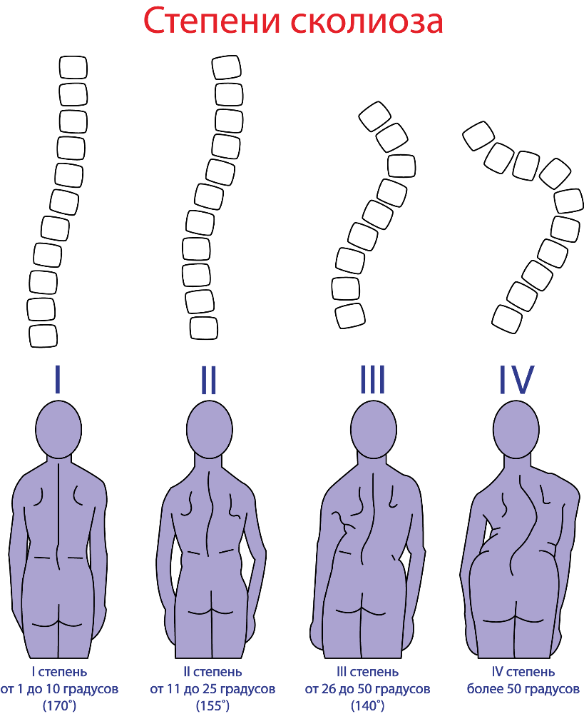 Сколиоз степени - причины заболевания, симптомы, диагностика и лечение.
