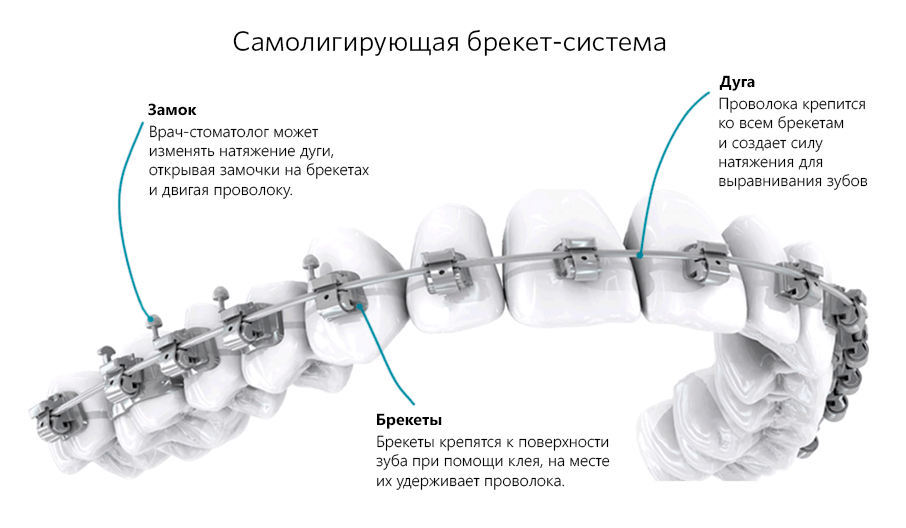 Презентация брекеты ортодонтия