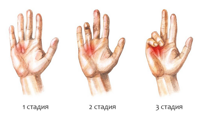Как устранить боль в суставе большого пальца на руке?