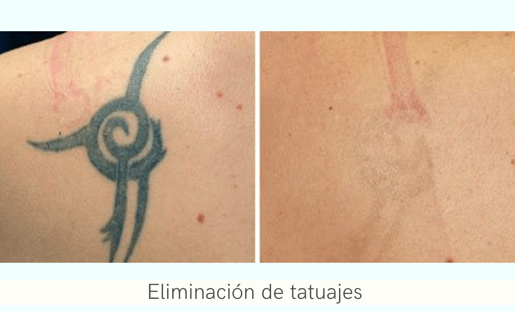 Удаление татуировок вырезанием