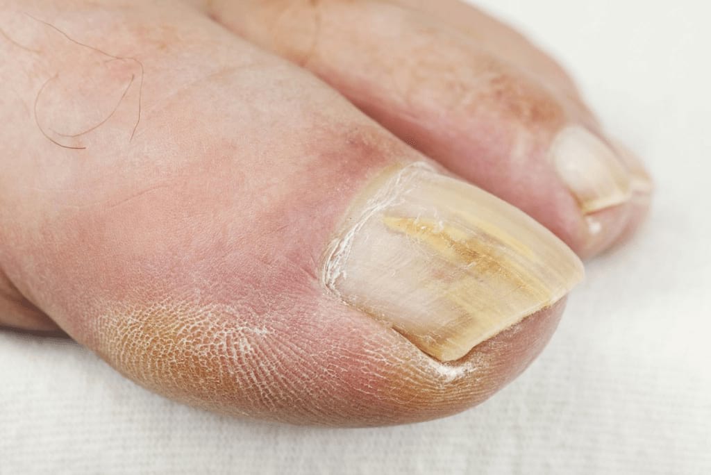 Причины заражения грибком ногтей на ногах