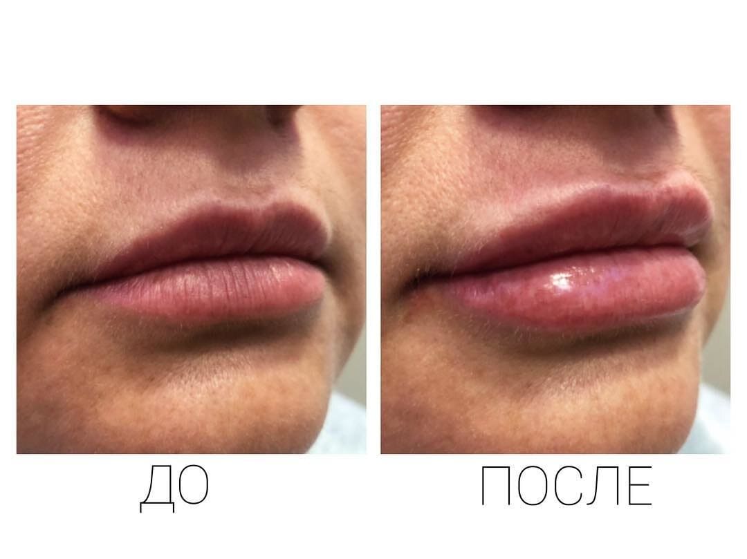 Шугаринг губа. Лазерная эпиляция верхней губы до и после. Электроэпиляция верхней губы. Электроэпиляция верхней губы фото до и после. Усы до и после депиляции.