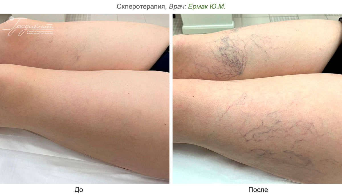Склеротерапия вен – процедура, признанная во всем мире, как золотой  стандарт.