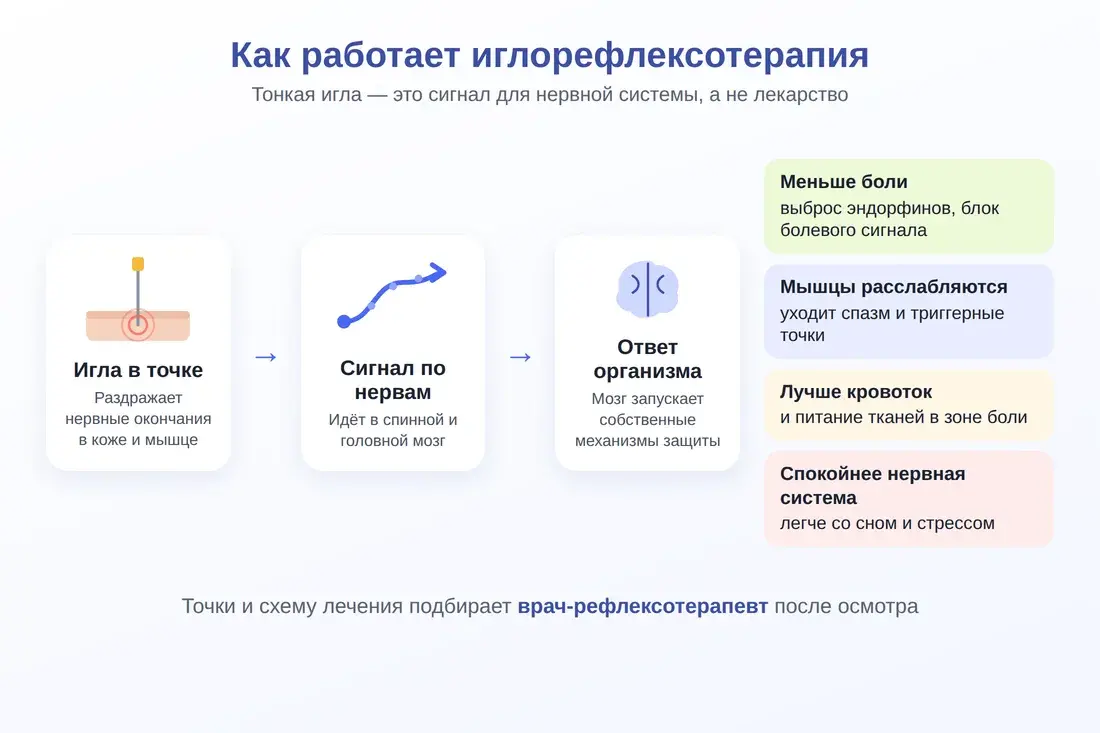 Схема: как работает иглорефлексотерапия — от иглы в точке к ответу нервной системы