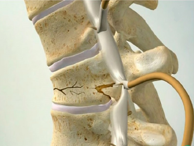 Перелом позвоночника картинки