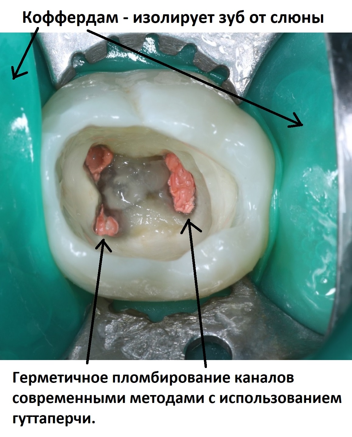 Лечение каналов зубов