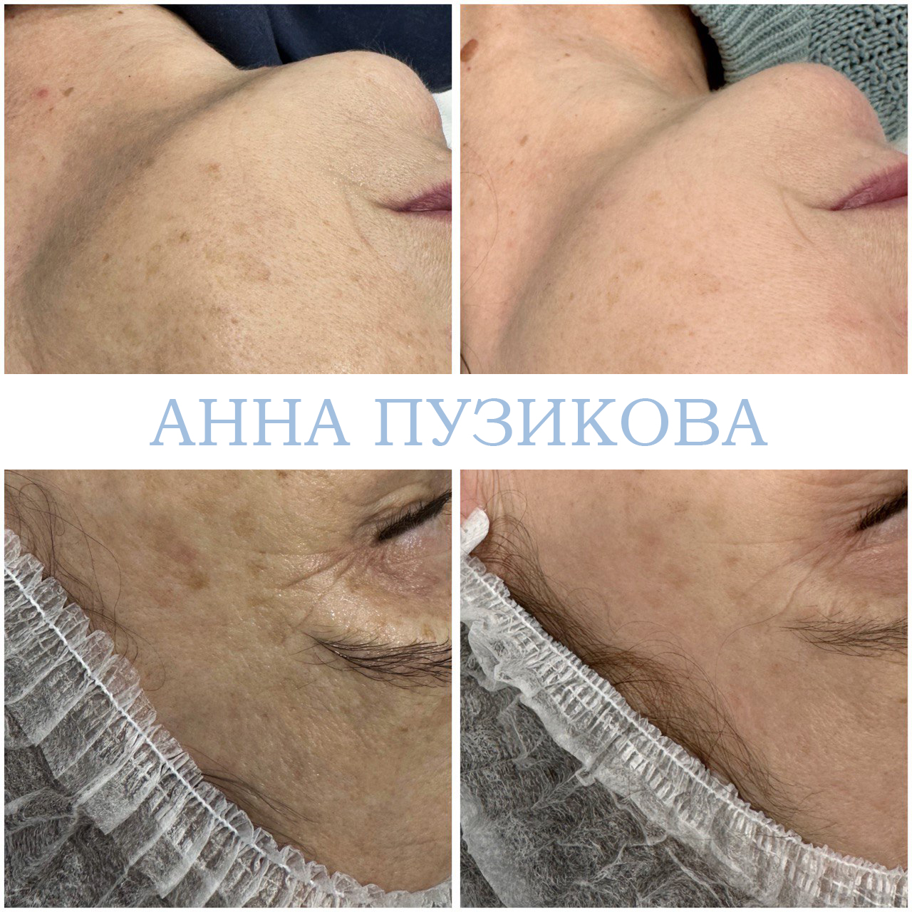 Результат удаления пигментных пятен после курса фототерапии ClearLight IPL — врач-косметолог Пузикова Анна Анатольевна, Санкт-Петербург