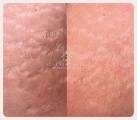 удаление растяжек цена москва