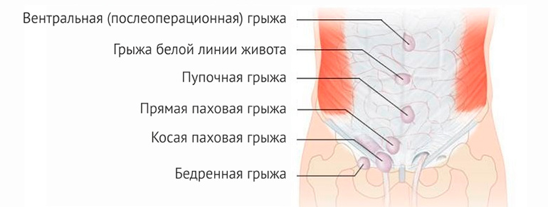 Прямую паховую грыжу характеризует слабость следующей стенки