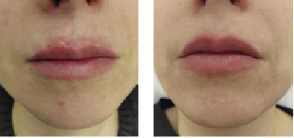 Простуда на губах: симптомы инфекции и методы избавления