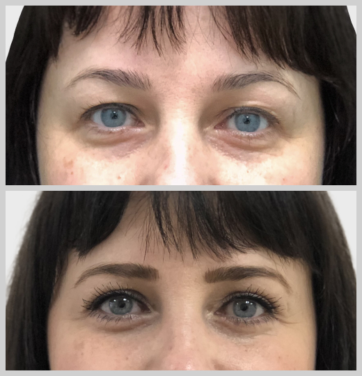 блефаропластика нависшие веки