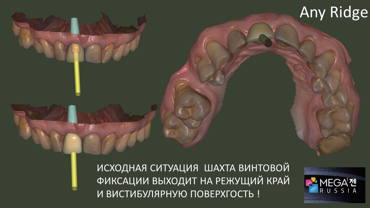 Фиксация в наклонной шахте винта с помощью отвертки от Мегаген