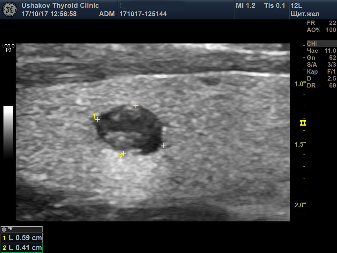 Узлы щитовидной железы 7 мм