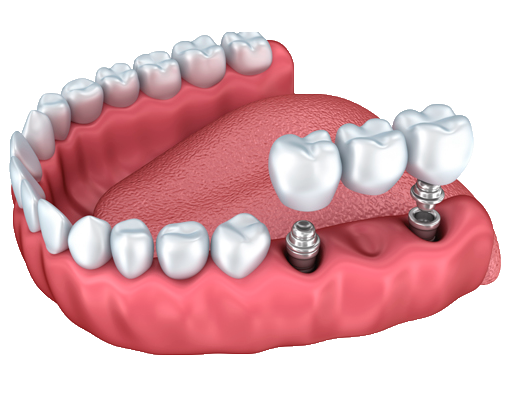 Установка имплантов в Дербенте. Имплантация при отсутствии одного или нескольких зубов, расположенных рядом.