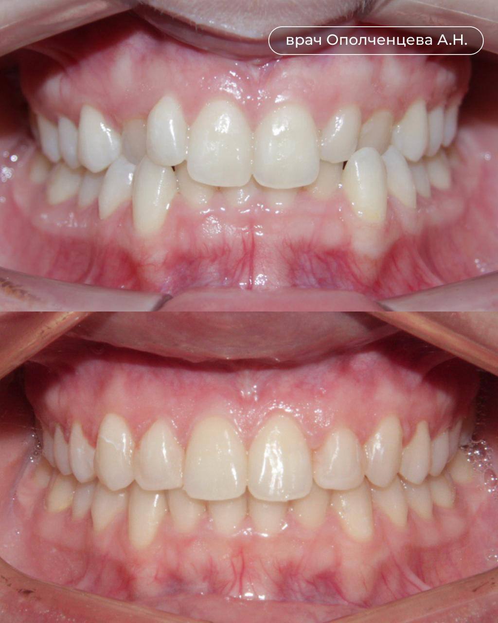Лечение элайнерами - До и После