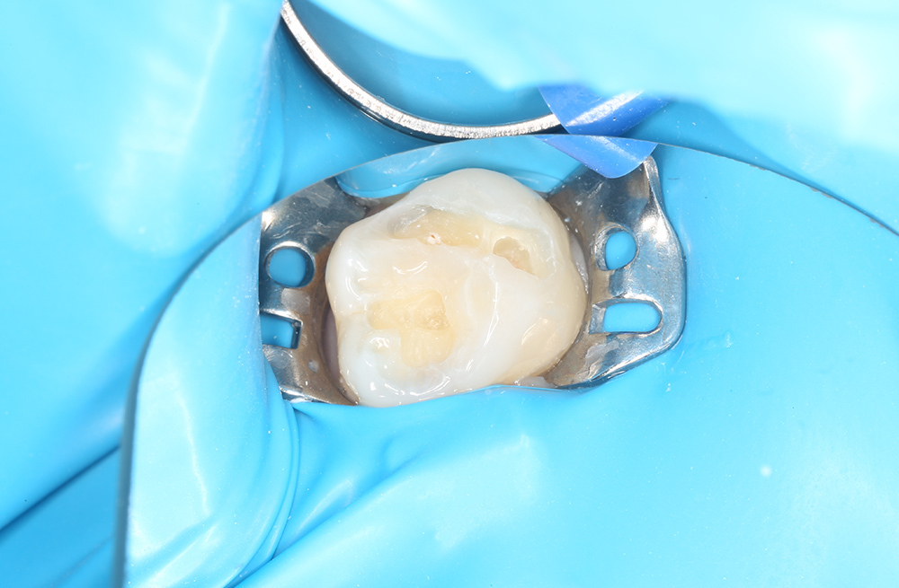 Лечение кариеса на жевательной поверхности постоянного зуба у подростка