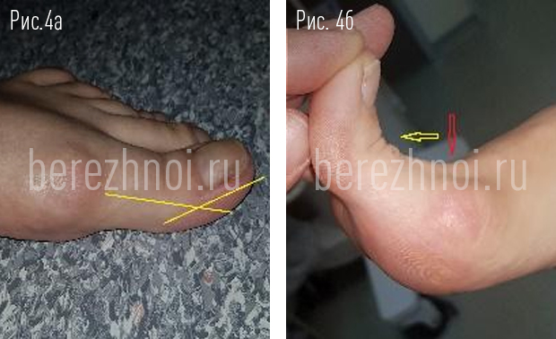 Что такое бурсит большого пальца стопы (Hallux Valgus)? Понимание причин и симптомов