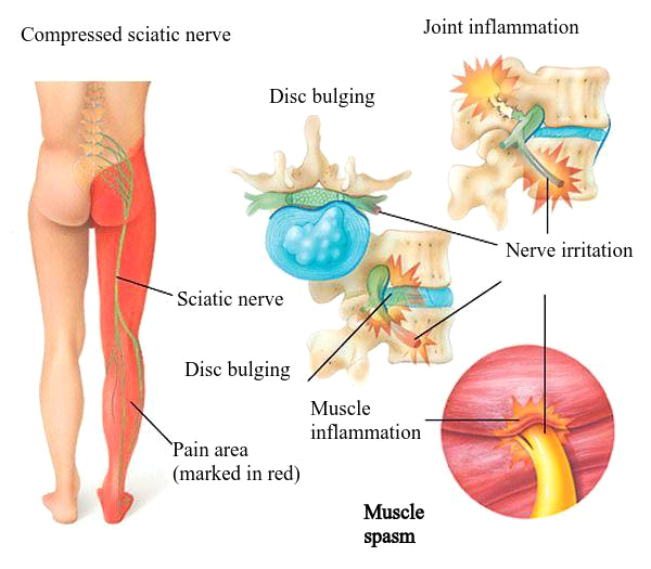 Herniated disc - Symptoms, Causes and Treatments