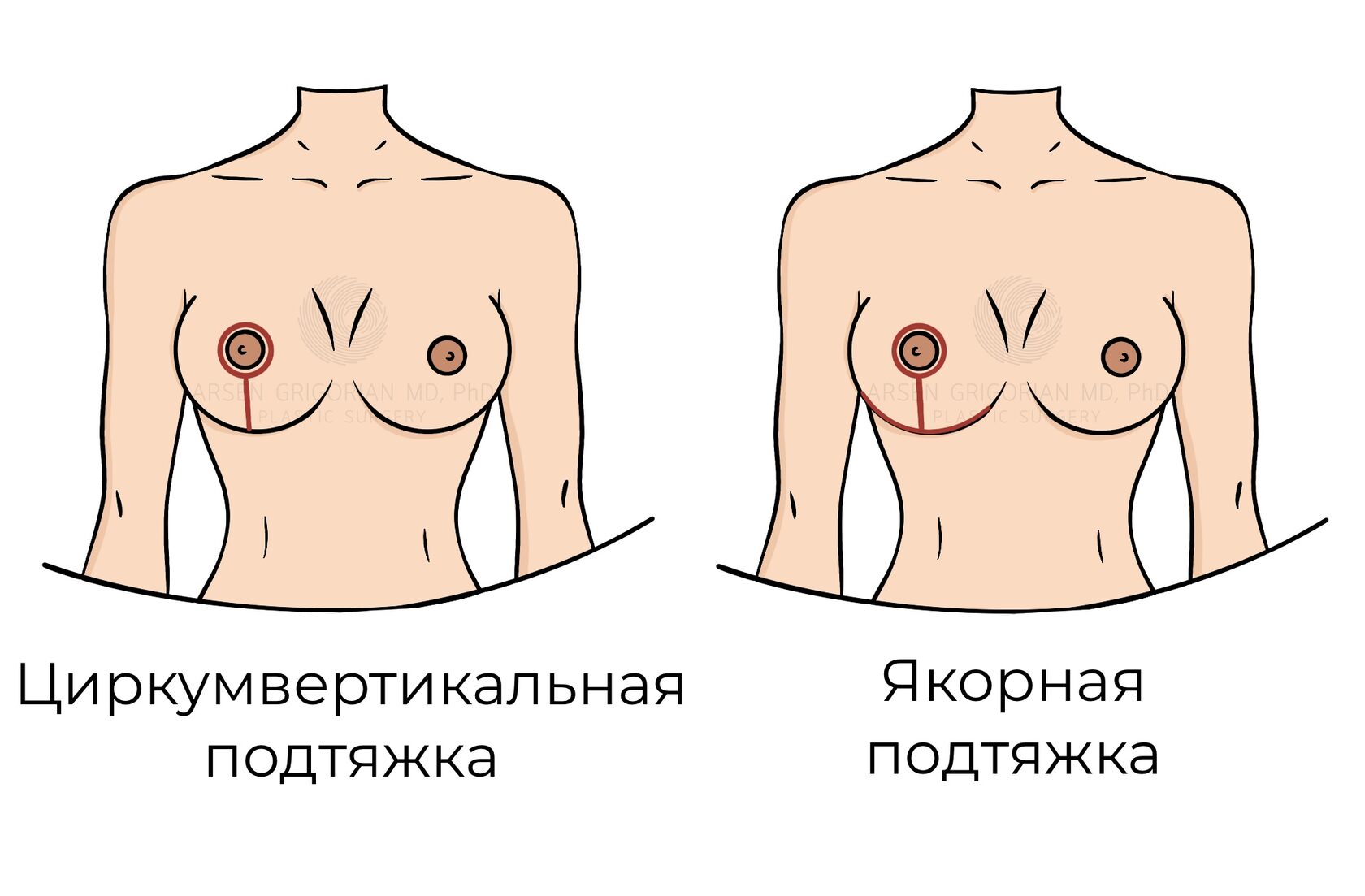 Операция по уменьшению груди