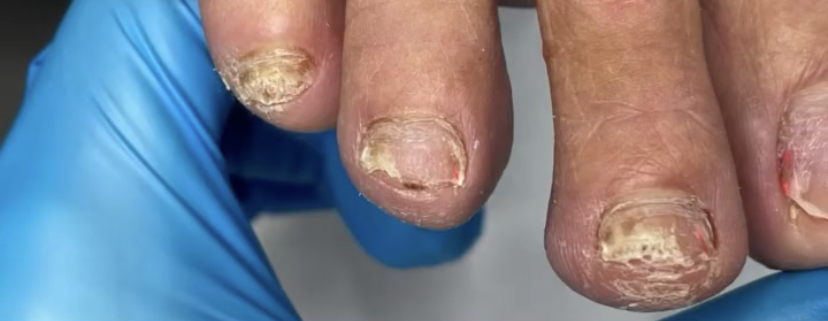 Грибковые поражения ногтей и кожи: у пациента должно быть огромное терпение