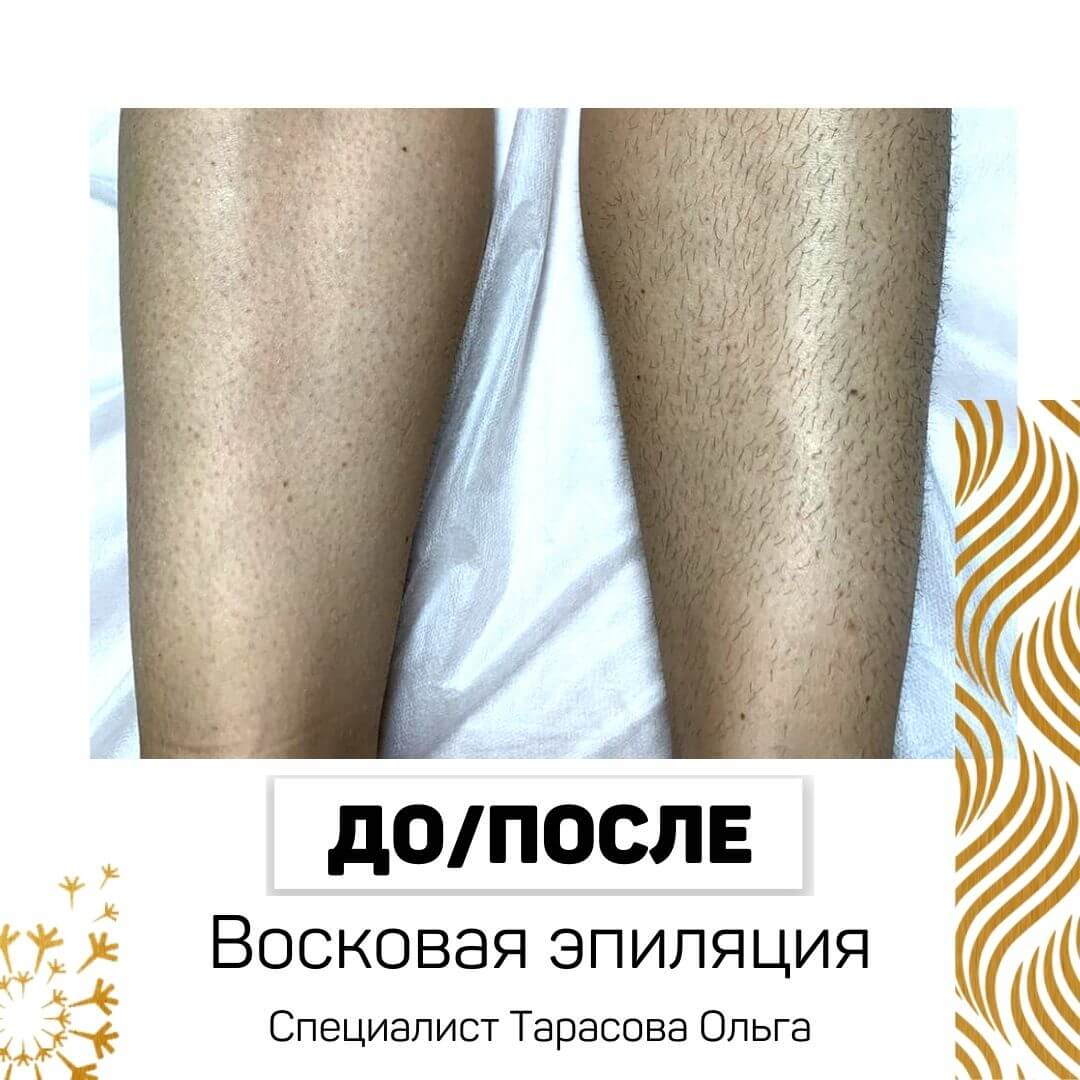 Эпиляция химки