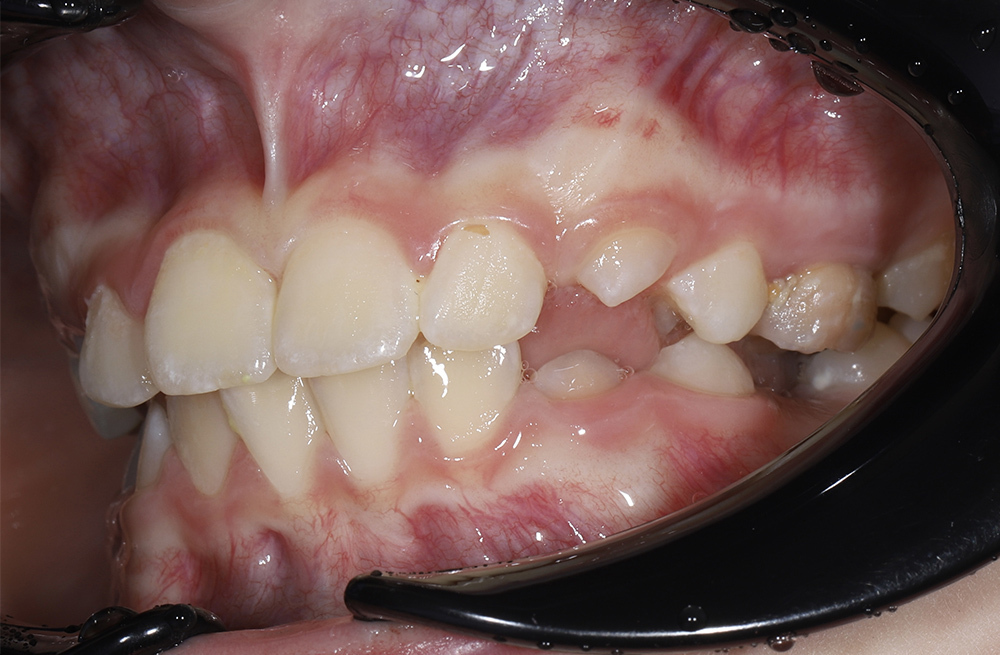 Исправление неровных зубов у ребенка с использованием частичной брекет-системы 2х4