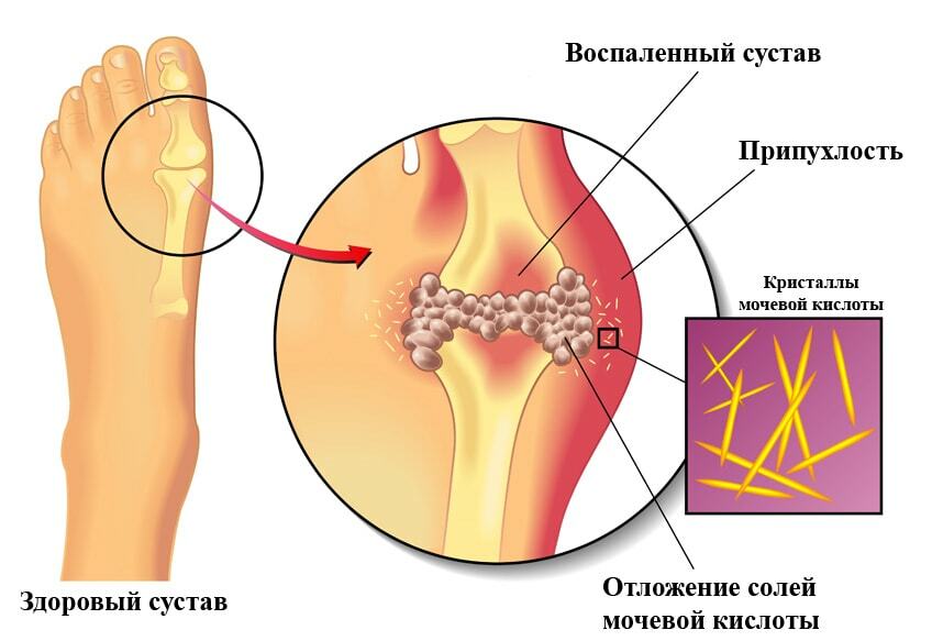 Подагра: смертельная болезнь или нет?